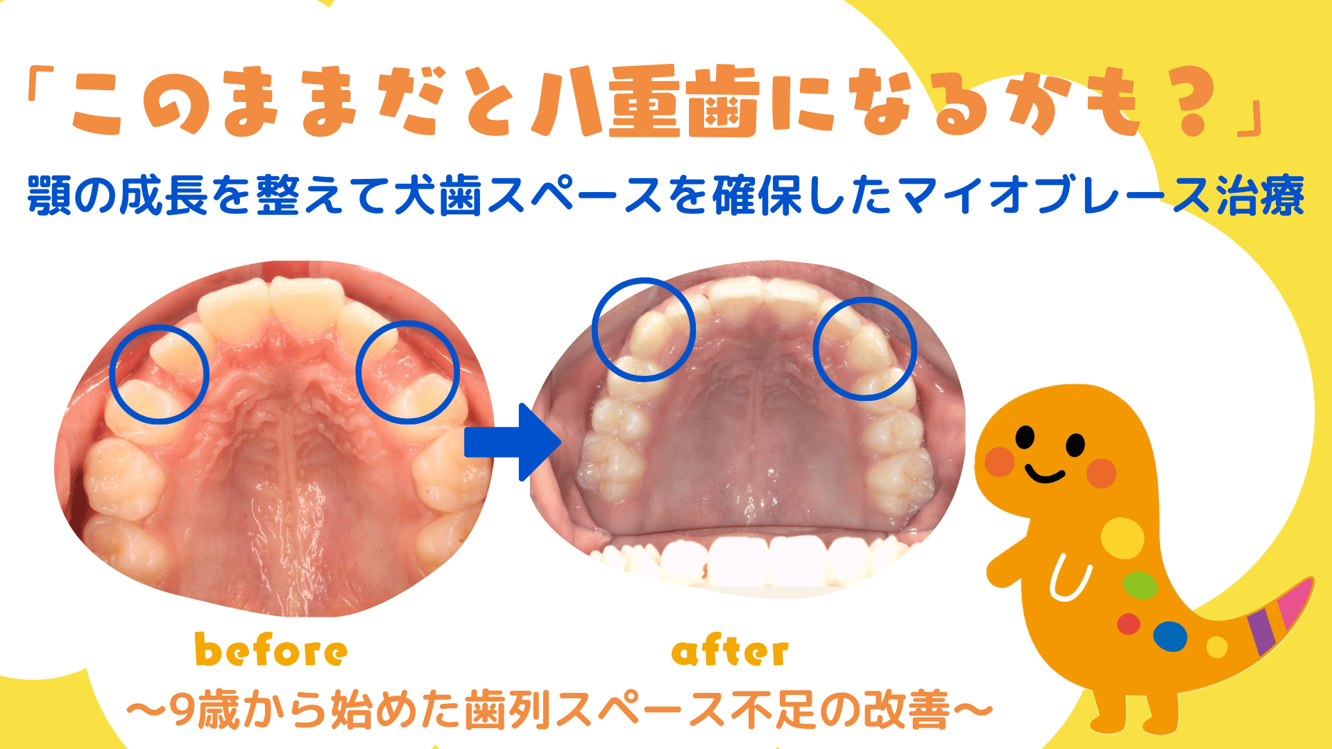 「このままだと八重歯になるかも?」 顎の成長を整えて犬歯スペースを確保したマイオブレース治療 〜9歳から始めた歯列スペース不足の改善〜
