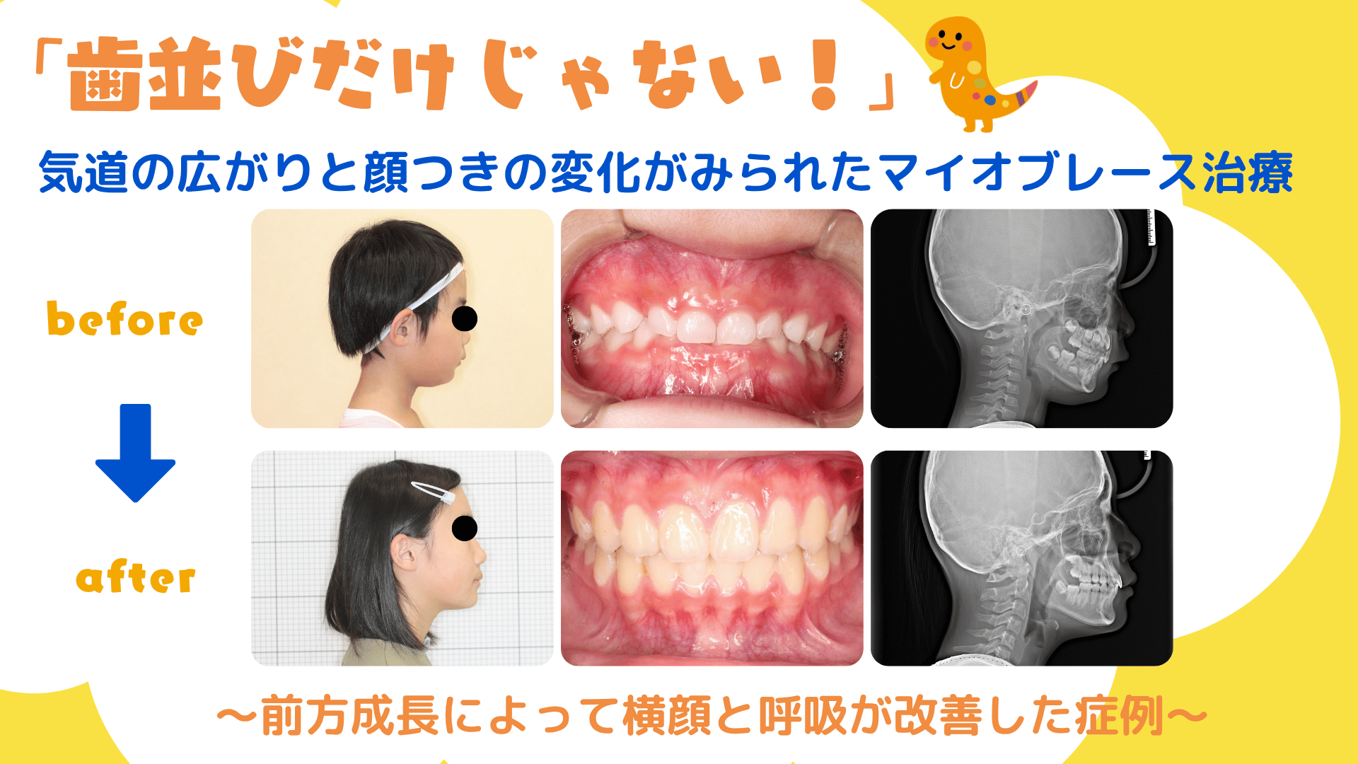 「歯並びだけじゃない!」 気道の広がりと顔つきの変化がみられたマイオブレース治療 〜前方成長によって横顔と呼吸が改善した症例〜